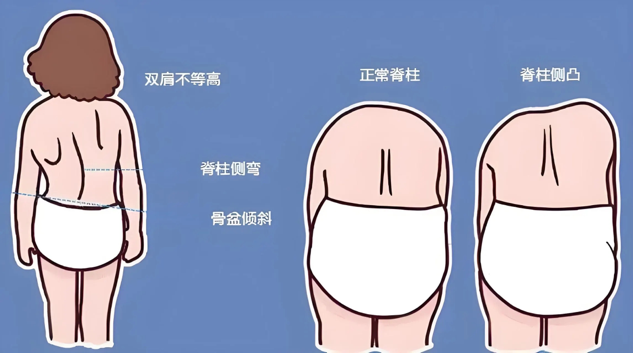 12歲“熊貓血”患兒脊柱側(cè)彎，醫(yī)生術(shù)后長高8公分