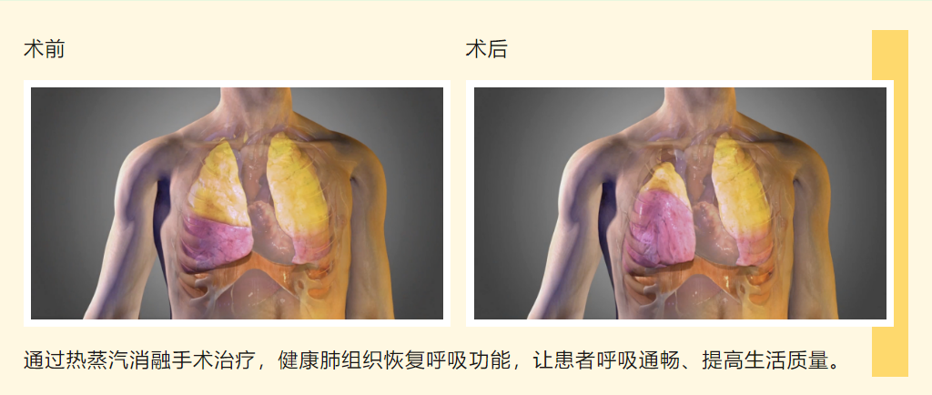 支氣管鏡“蒸汽盾”激活肺動(dòng)力——湖北省第三人民醫(yī)院開展靶向熱蒸汽消融術(shù)，讓慢阻肺患者告別“窒息人生”