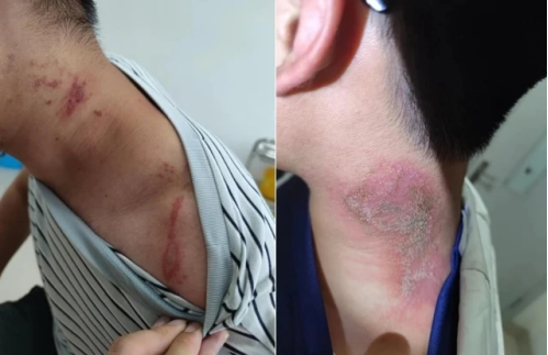 夏日“隱形殺手”出沒！專家提醒：防隱翅蟲皮炎，切記“兩沖洗一就醫(yī)”